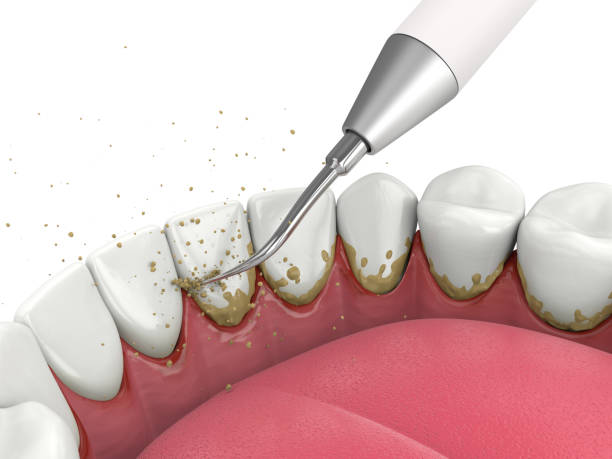 Dental Cleaning image